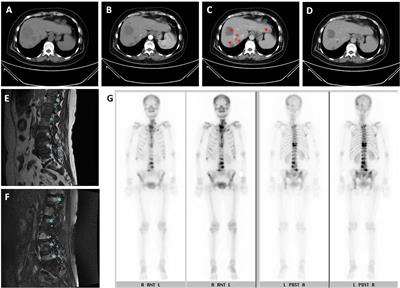 Efficacy of Cyproheptadine Monotherapy in Hepatocellular Carcinoma With Bone Metastasis: A Case Report